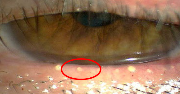 マイボーム腺機能不全