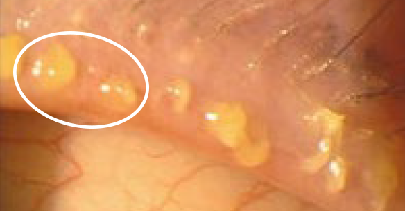 マイボーム腺機能不全