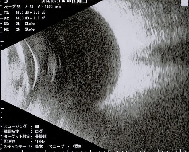 超音波断層撮影（Ｂモード）