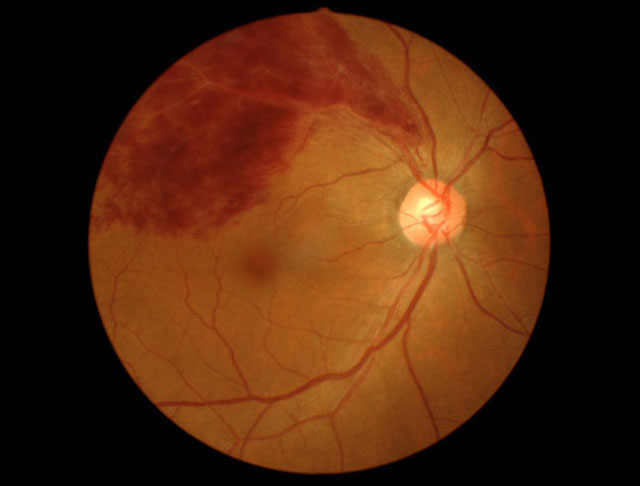 眼底出血（網膜中心静脈閉塞症）