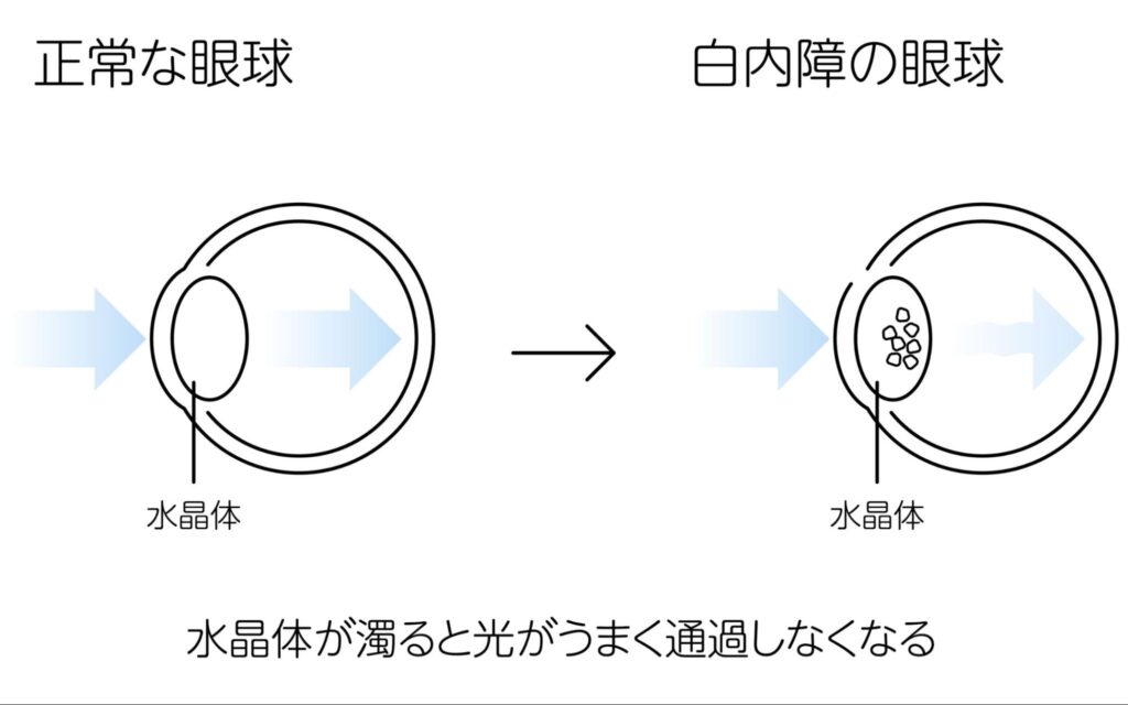 白内障の原因