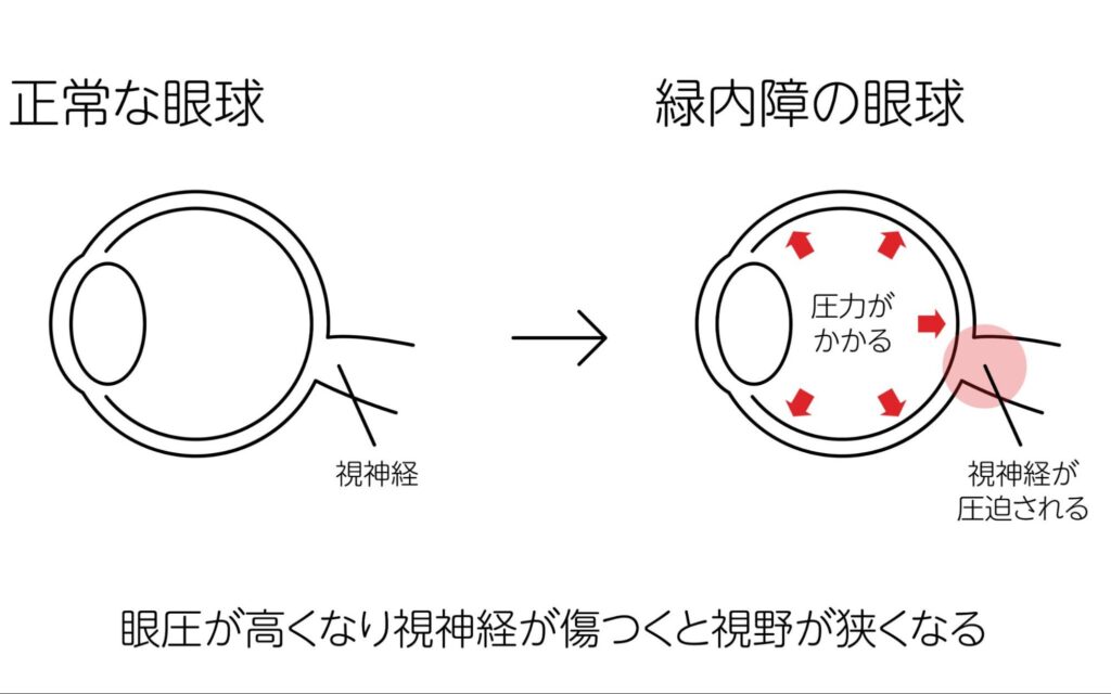 緑内障 症状