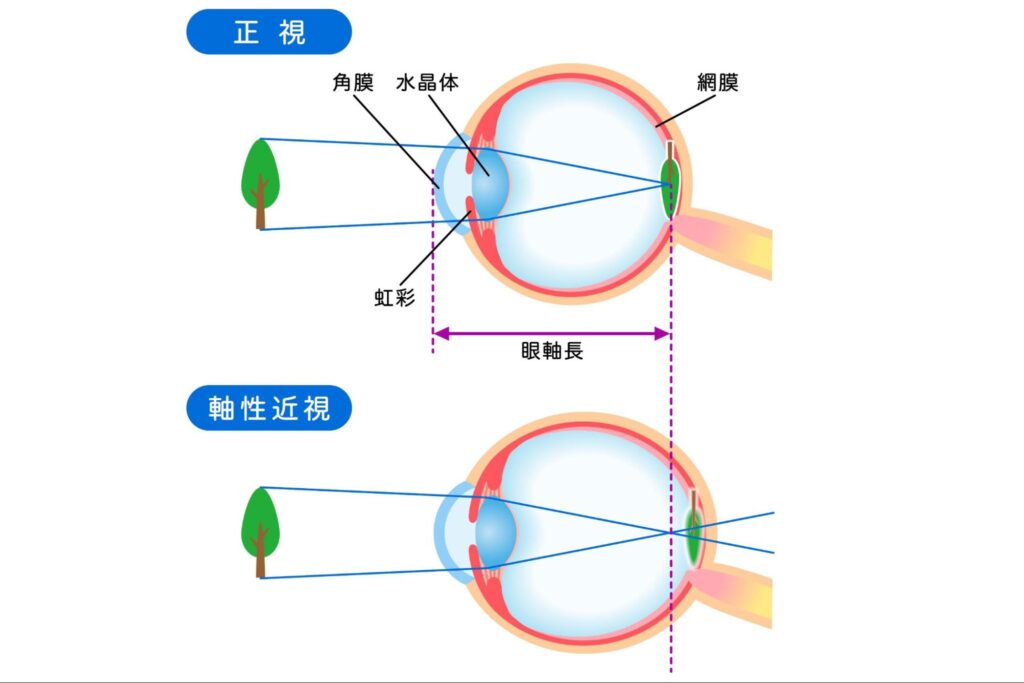 近視 原因