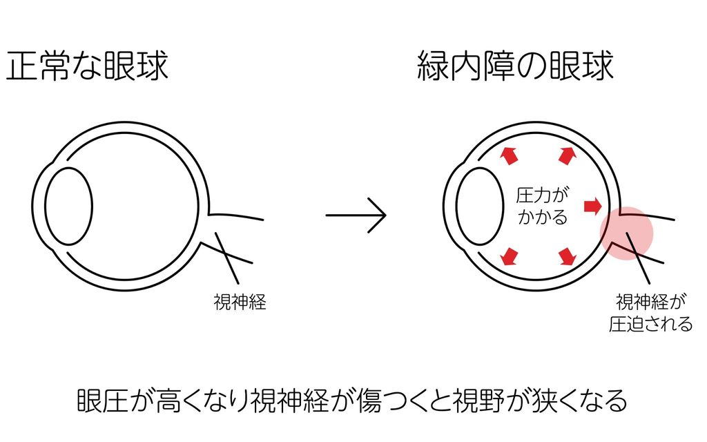 正常な眼球と緑内障の眼球のイラスト