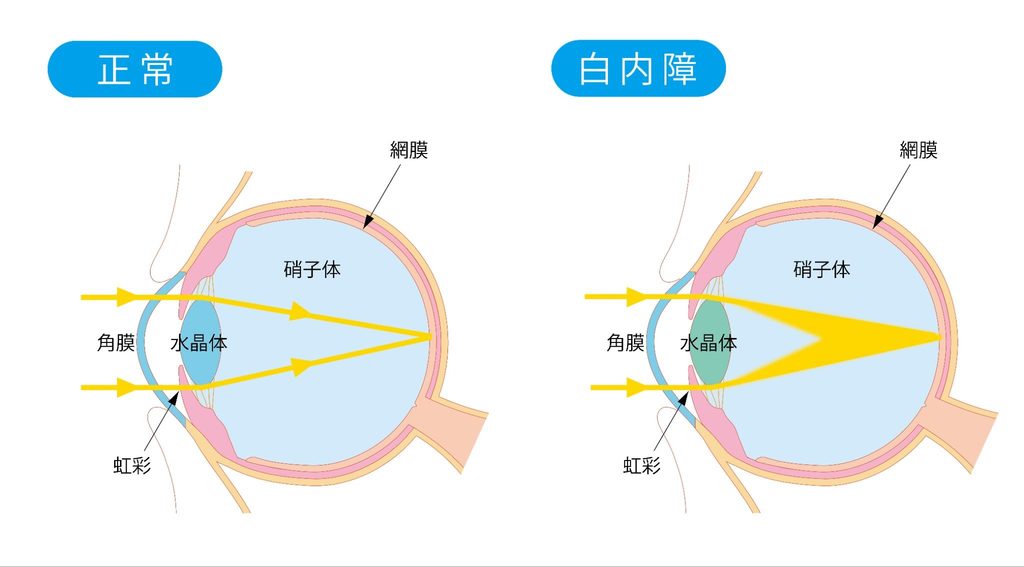 正常な目と白内障の目のイラスト