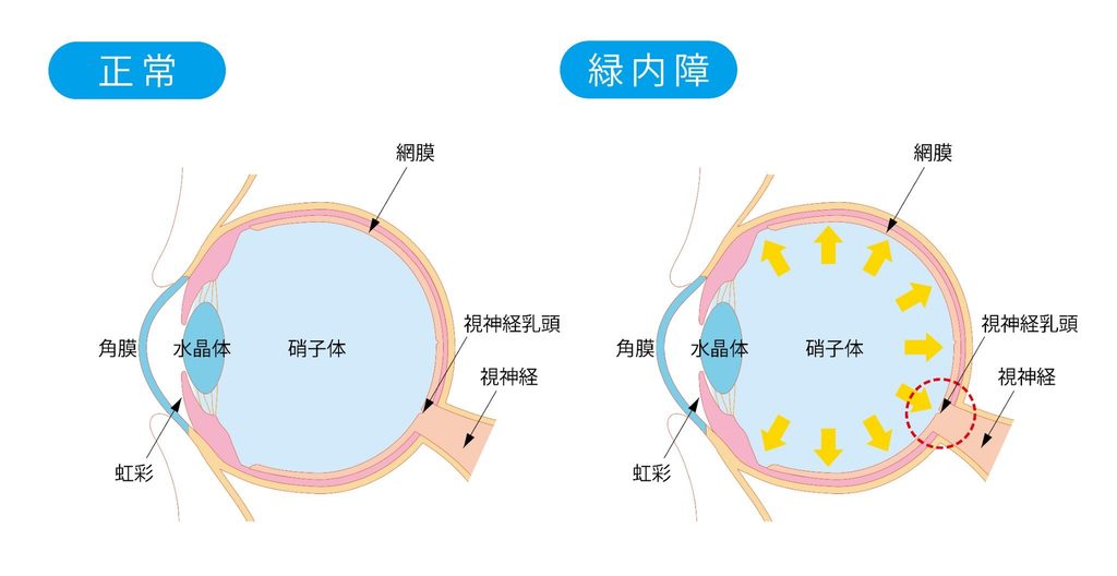 正常な目と緑内障の目の構造のイラスト